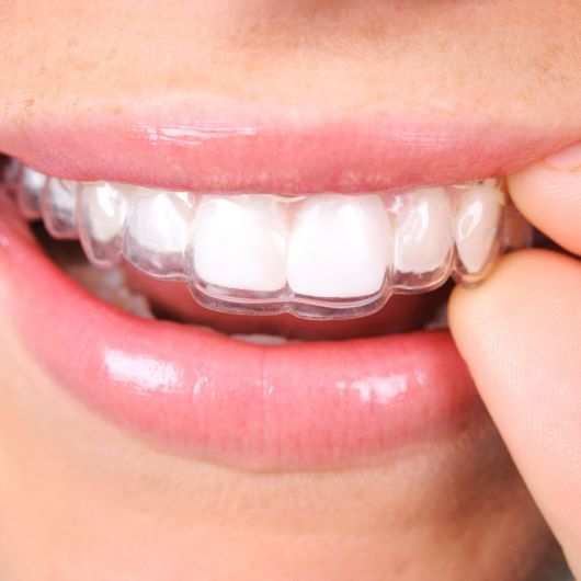Eine Nahaufnahme des Mundes einer Person, die eine durchsichtige Zahnschiene über die oberen Zähne legt. Die Lippen der Person sind leicht gescheitelt und zeigen gerade weiße Zähne und die transparente kieferorthopädische Vorrichtung.