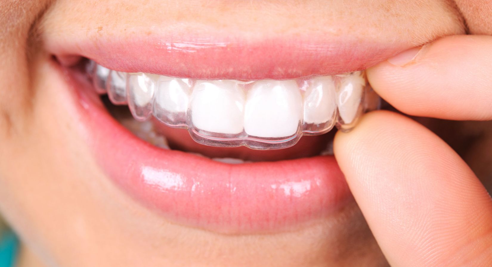 Eine Nahaufnahme des Mundes einer Person, die eine durchsichtige Zahnschiene über die oberen Zähne legt. Die Lippen der Person sind leicht gescheitelt und zeigen gerade weiße Zähne und die transparente kieferorthopädische Vorrichtung.